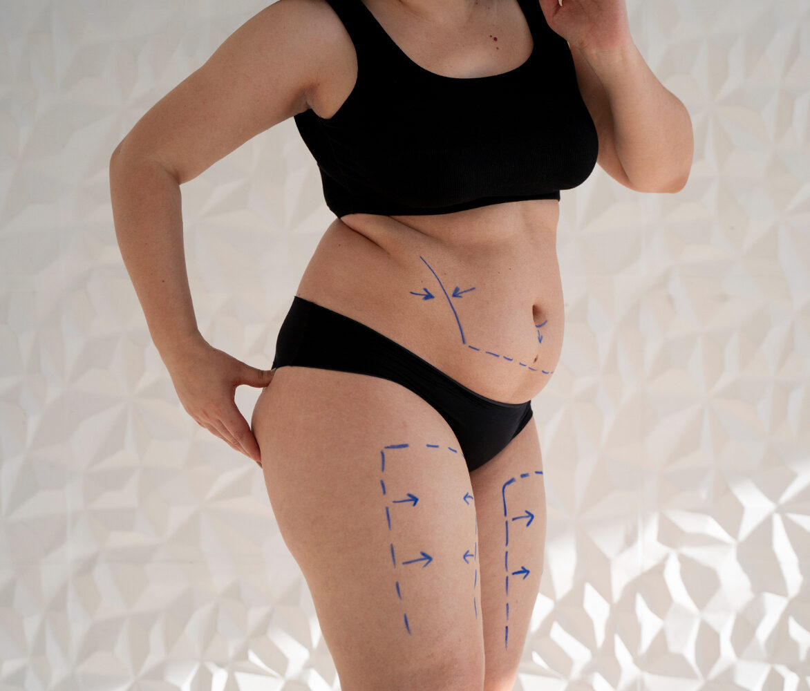 ¿Qué es el Mommy Makeover y sus riesgos?