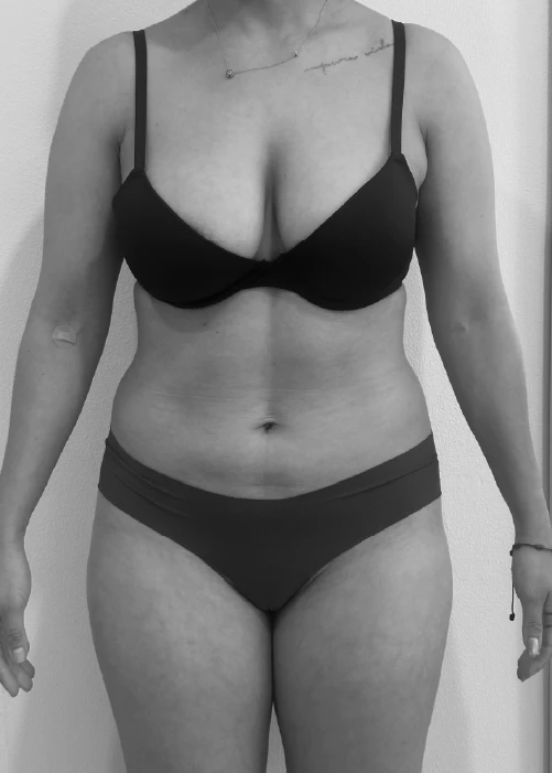 Beneficios de la Liposucción