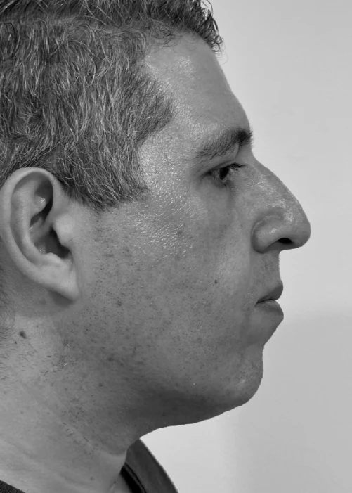 Beneficios de Rinoplastia