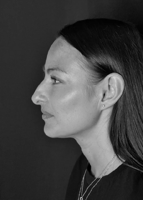 Beneficios de Rinoplastia