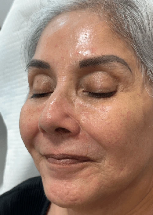 Beneficios de los Bioestimuladores