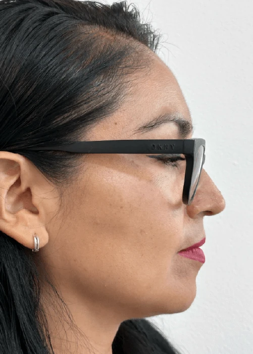 Beneficios de los Bioestimuladores