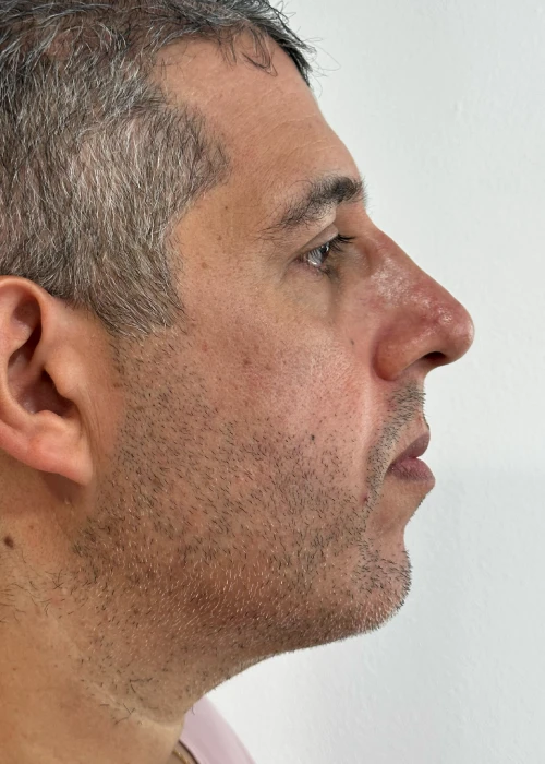 Beneficios de Rinoplastia