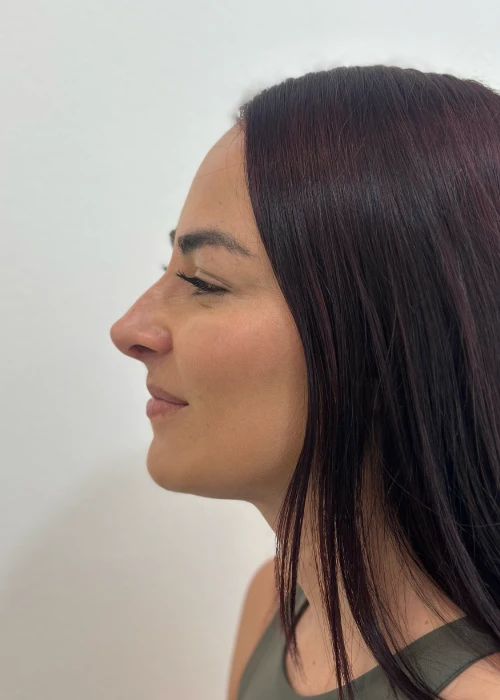 Beneficios de Rinoplastia