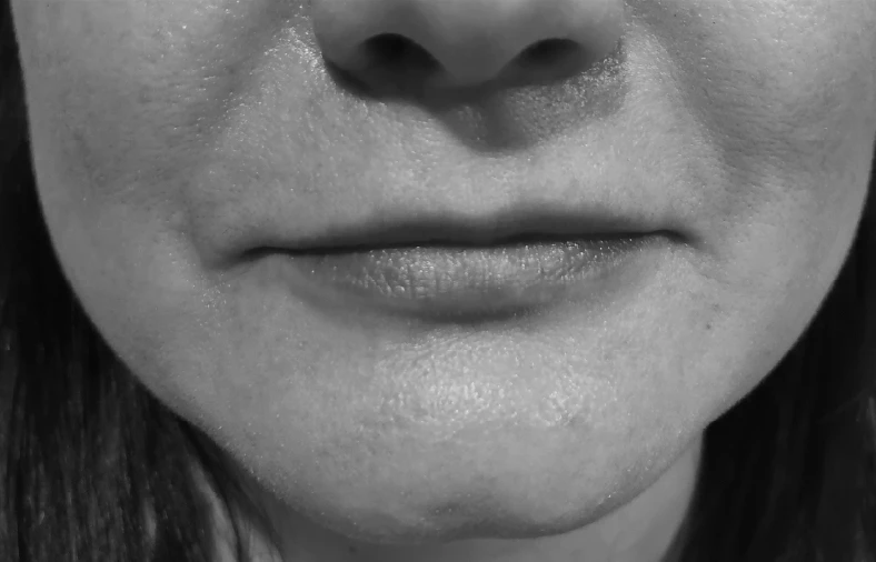 Beneficios de los Rellenos / Fillers